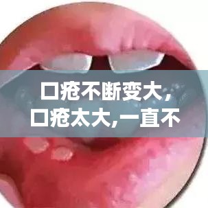 口疮不断变大，口疮太大,一直不好 