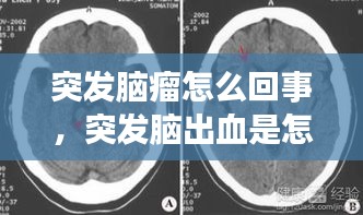 突发脑瘤怎么回事，突发脑出血是怎么回事 